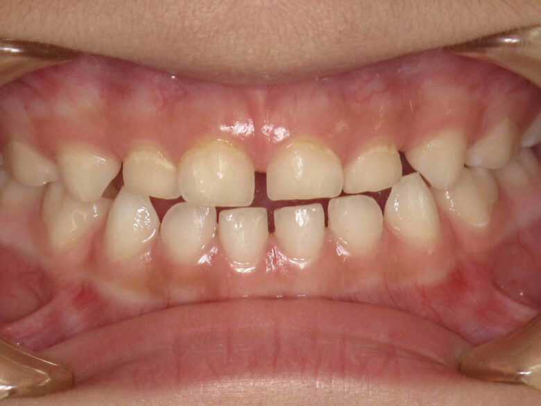 治るむし歯（乳歯初期むし歯）