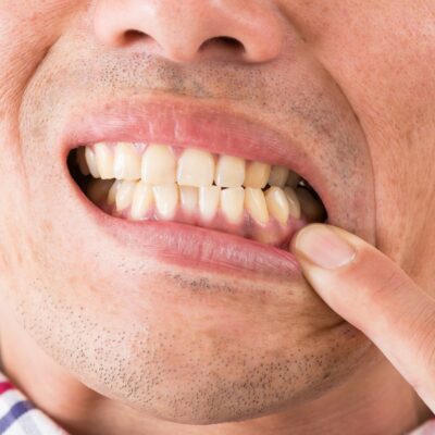 歯周病男性