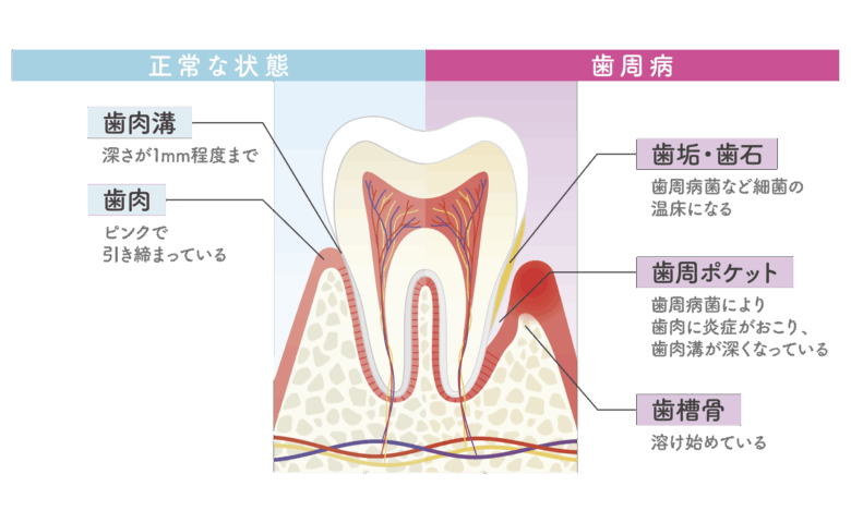 歯周病と正常歯肉との比較